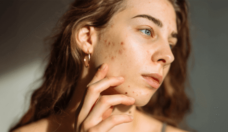 Die besten Nahrungsergänzungsmittel und Diäten zur Bekämpfung von Akne