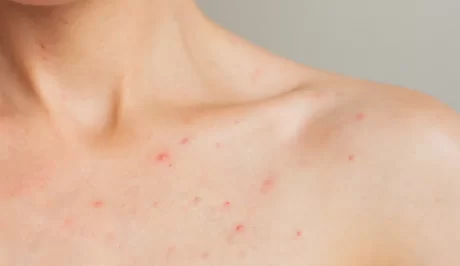 Gesundes Hautbild bei hormonellen Veränderungen