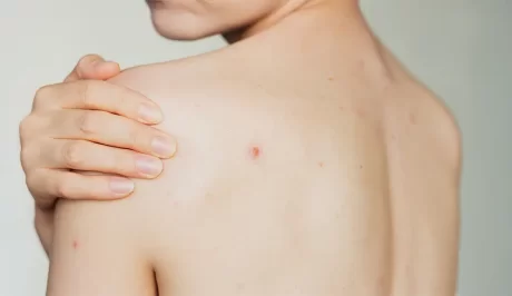 Hormonstörungen und Hautzustand